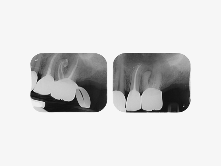 Endodontic treatment of tooth 4.6, as the tooth was symptomatic.