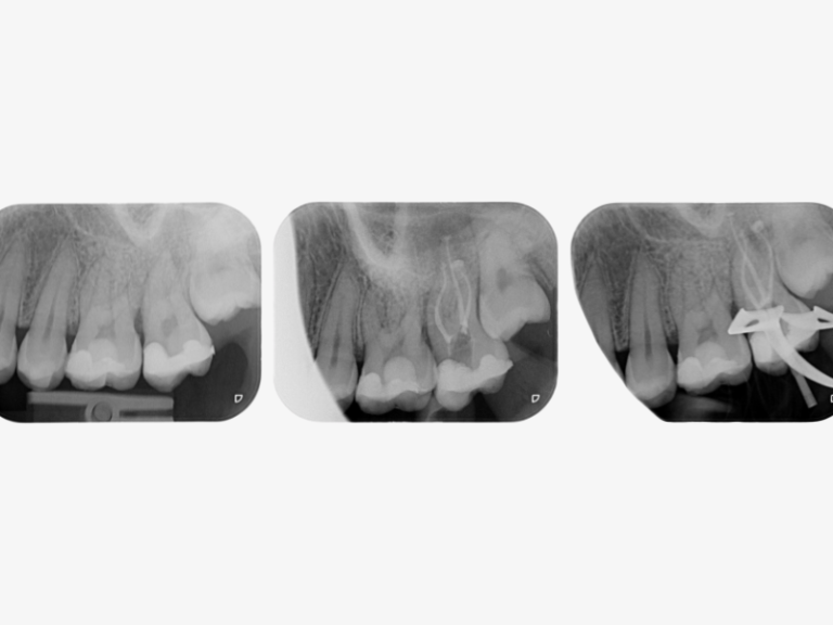 Irreversible pulpitis (Wolters Classification: severe pulpitis). Patient referred for root canal treatment of tooth 27 due to Irreversible pulpitis (Wolters Classification: severe pulpitis). 