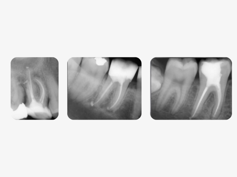 Three cases - All handled with the EdgeEndo system; files and sealer.
