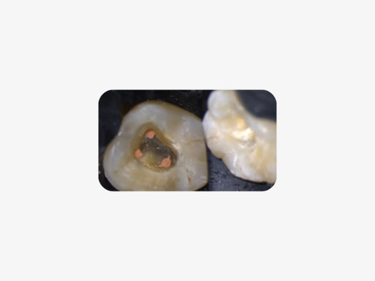 Endodontic treatment of tooth 4.6, as the tooth was symptomatic.
