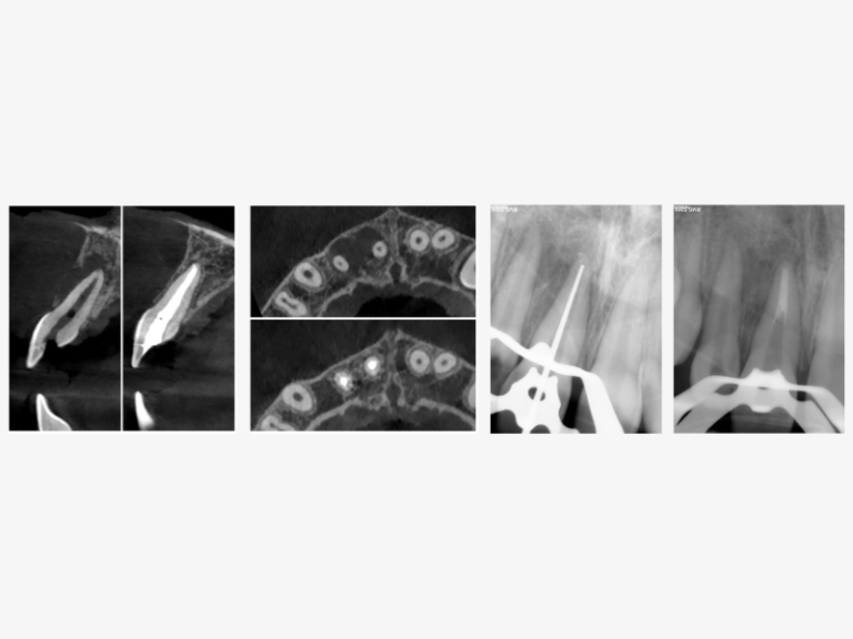 1-Year Follow-Up Showing the complete healing of the periapical lesion on teeth #11 and #12.