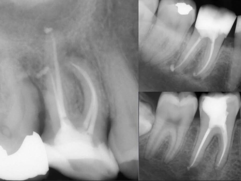 edge-endo-endodontics-root-canals-rootcanal-treatment